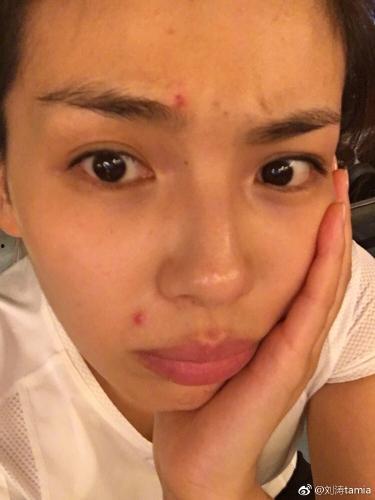 痘痘多的明星,揭秘痘痘频发背后的护肤秘籍